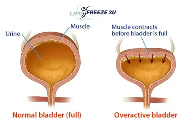 diagram of overactive bladder treatment Greater London