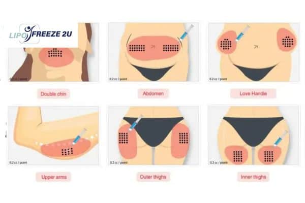 Benefits of Choosing Aqualyx for Fat Reduction Greater London