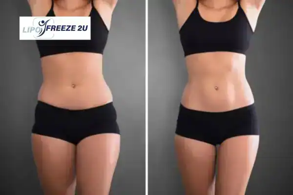 How Can LIPO FREEZE 2U Support Your Post-Pregnancy Body Recovery Greater London?