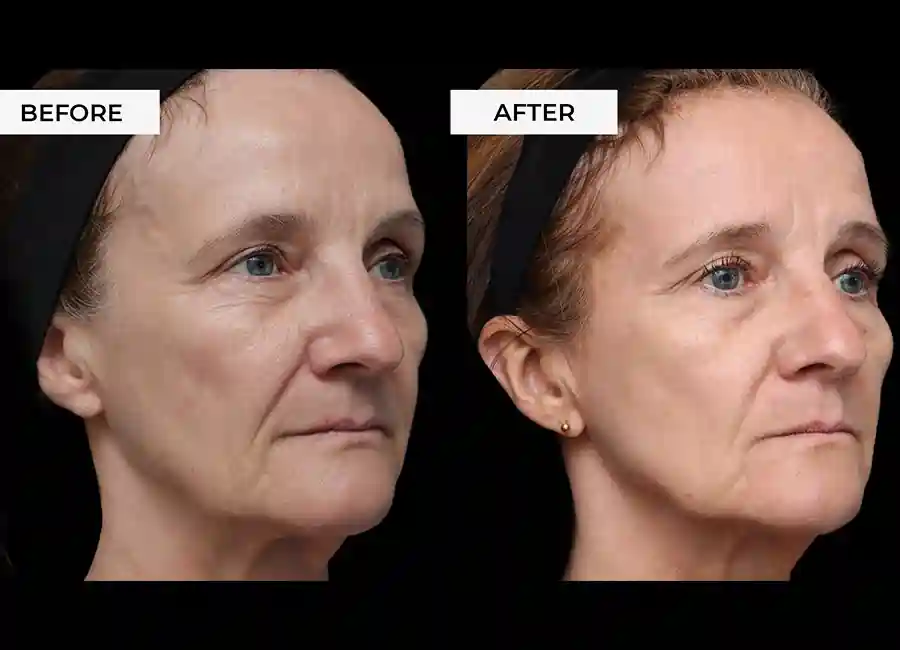 How Many RF Microneedling Sessions Will You Need to See a Difference Greater London?