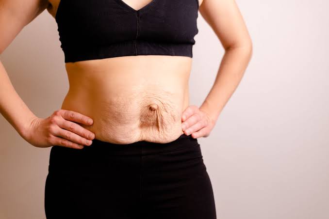 Is Surgery Really the Only Way to Repair Diastasis Recti Greater London?