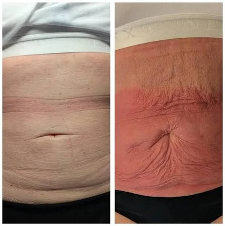 How Does RF Microneedling Improve Crepey, Thin and Uneven Skin Texture Greater London?