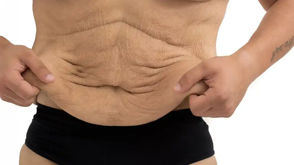 RF Microneedling for Loose Skin: How Can It Help Tighten and Reshape the Skin Greater London?